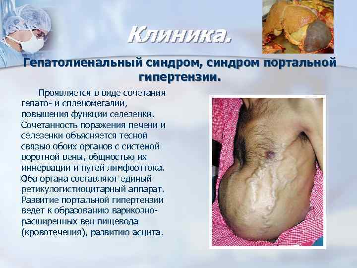 Клиника. Гепатолиенальный синдром, синдром портальной гипертензии. Проявляется в виде сочетания гепато- и спленомегалии, повышения