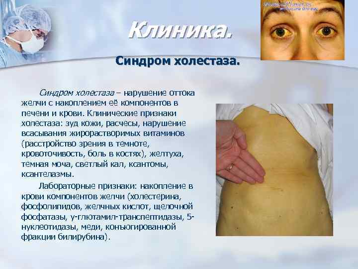 Клиника. Синдром холестаза – нарушение оттока желчи с накоплением её компонентов в печени и
