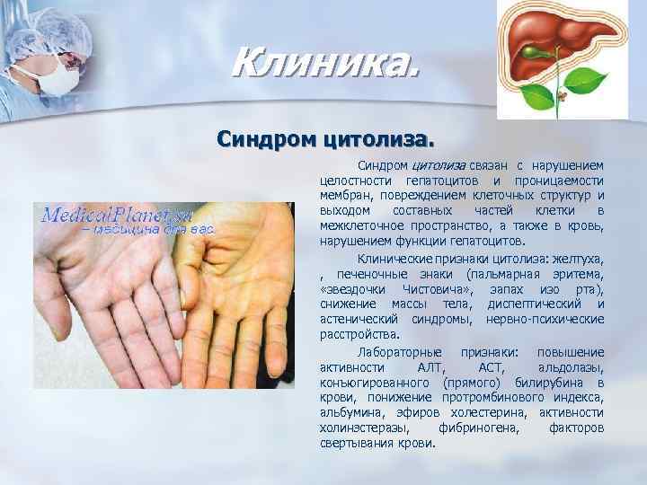 Клиника. Синдром цитолиза связан с нарушением целостности гепатоцитов и проницаемости мембран, повреждением клеточных структур