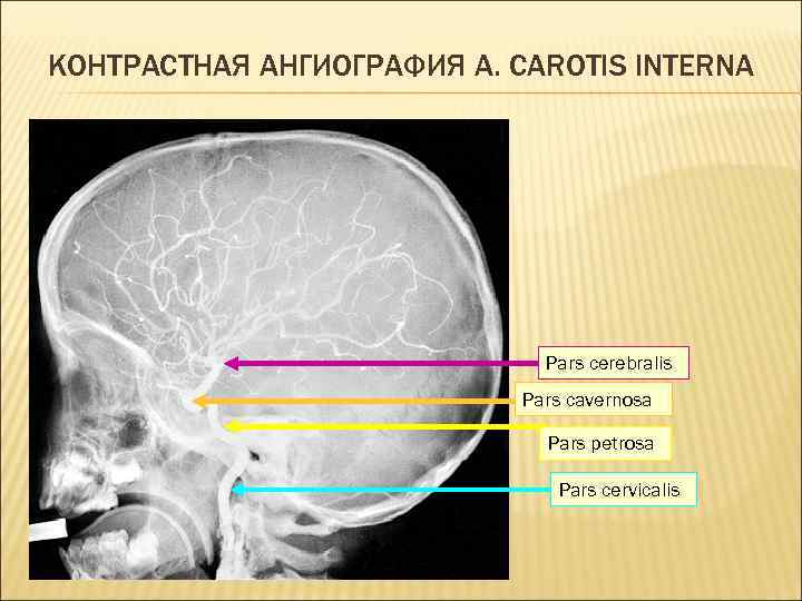 КОНТРАСТНАЯ АНГИОГРАФИЯ A. CAROTIS INTERNA Pars cerebralis Pars cavernosa Pars petrosa Pars cervicalis 