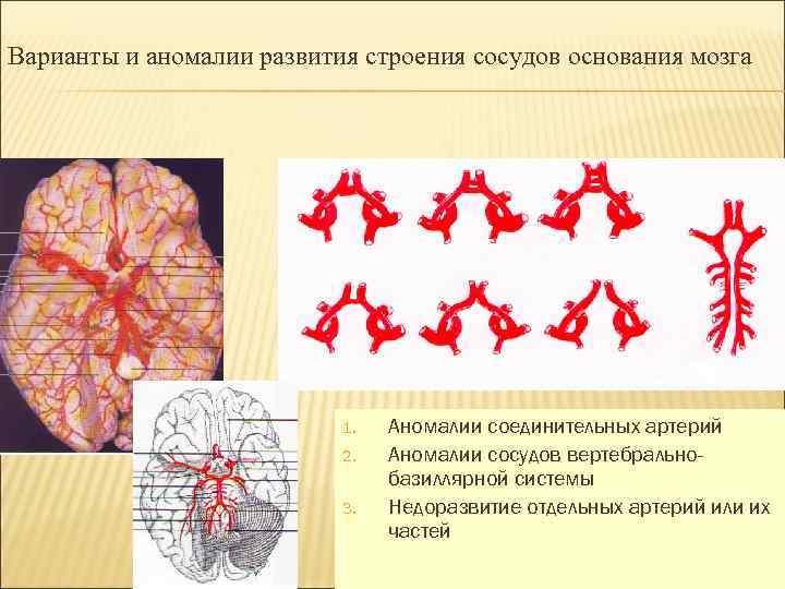 Варианты и аномалии развития строения сосудов основания мозга 1. 2. 3. Аномалии соединительных артерий