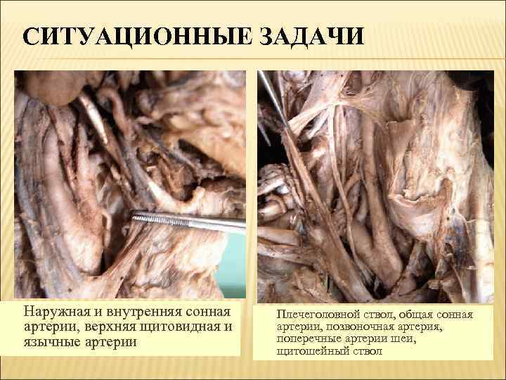 СИТУАЦИОННЫЕ ЗАДАЧИ Наружная и внутренняя сонная артерии, верхняя щитовидная и язычные артерии Плечеголовной ствол,