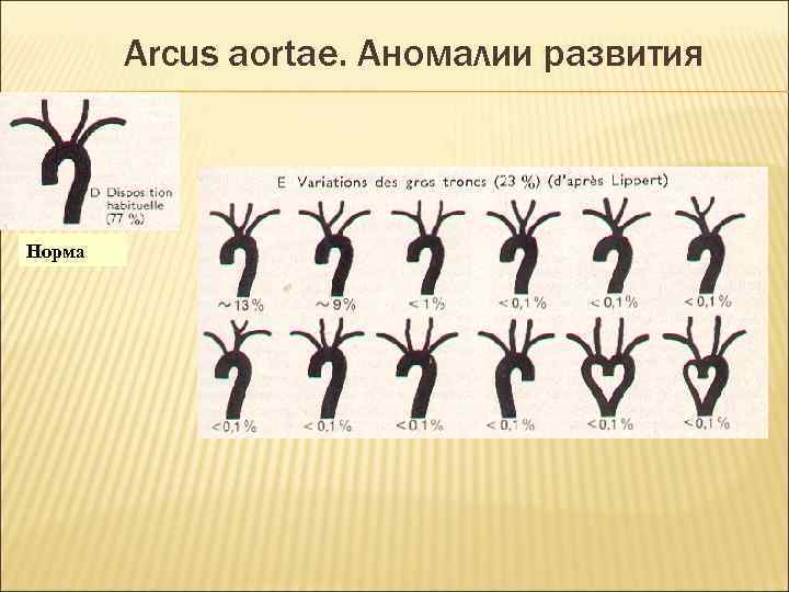 Arcus aortae. Аномалии развития Норма 