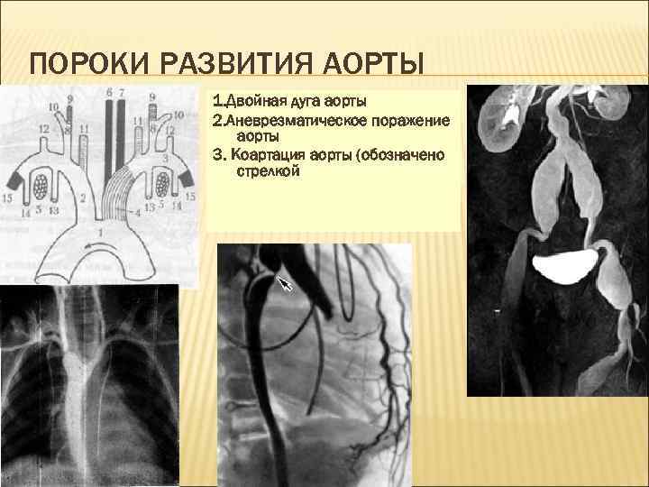 ПОРОКИ РАЗВИТИЯ АОРТЫ 1. Двойная дуга аорты 2. Aневрезматическое поражение аорты 3. Коартация аорты