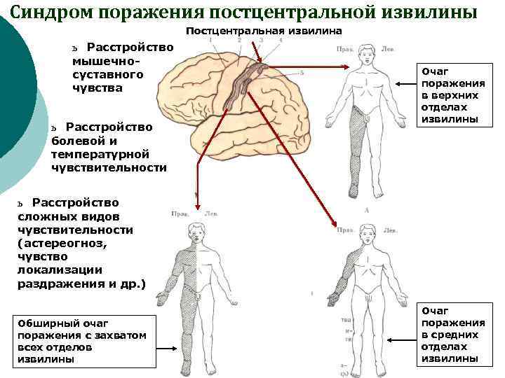 Синдром поражения постцентральной извилины Постцентральная извилина ь Расстройство мышечносуставного чувства ь Расстройство болевой и