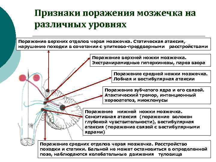 Признаки поражения мозжечка на различных уровнях Поражение верхних отделов червя мозжечка. Статическая атаксия, нарушение