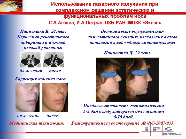 Использование лазерного излучения при комплексном решении эстетических и функциональных проблем носа С. А. Агеева,