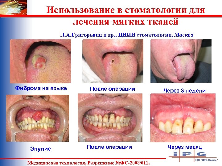 Использование в стоматологии для лечения мягких тканей Л. А. Григорьянц и др. , ЦНИИ