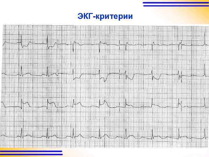 ЭКГ-критерии 