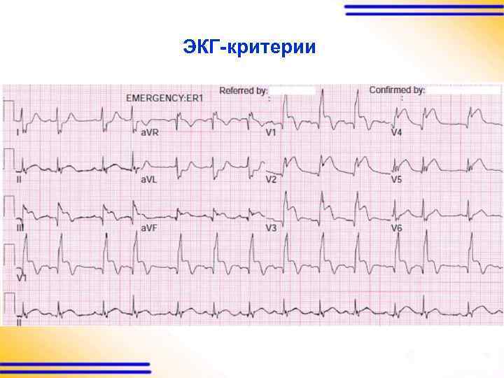 ЭКГ-критерии 