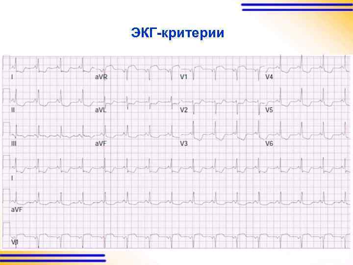 ЭКГ-критерии 