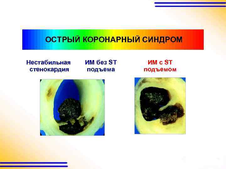 ОСТРЫЙ КОРОНАРНЫЙ СИНДРОМ Нестабильная стенокардия ИМ без ST подъема ИМ с ST подъемом 