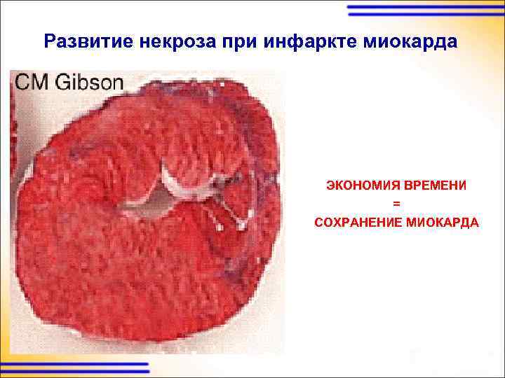 Развитие некроза при инфаркте миокарда ЭКОНОМИЯ ВРЕМЕНИ = СОХРАНЕНИЕ МИОКАРДА 
