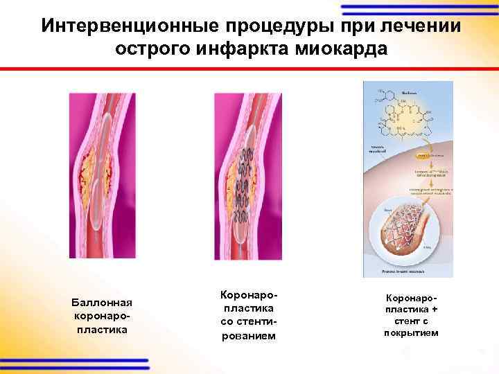 Интервенционные процедуры при лечении острого инфаркта миокарда Баллонная коронаропластика Коронаропластика со стентированием Коронаропластика +