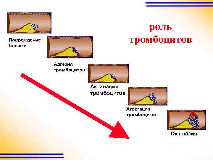 роль тромбоцитов Повреждение бляшки Адгезия тромбоцитов Активация тромбоцитов Агрегация тромбоцитов Окклюзия 