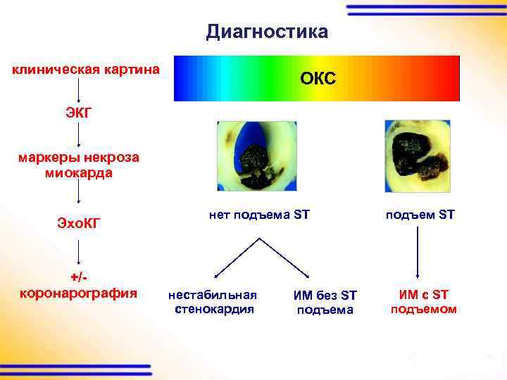 Диагностика клиническая картина ОКС ЭКГ маркеры некроза миокарда Эхо. КГ +/коронарография нет подъема ST