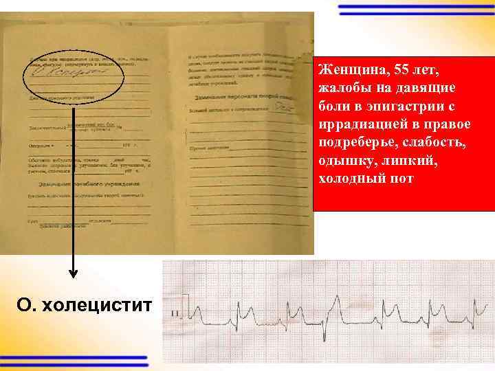 Женщина, 55 лет, жалобы на давящие боли в эпигастрии с иррадиацией в правое подреберье,