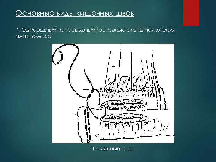Основные виды кишечных швов 1. Однорядный непрерывный (основные этапы наложения анастомоза) Начальный этап 