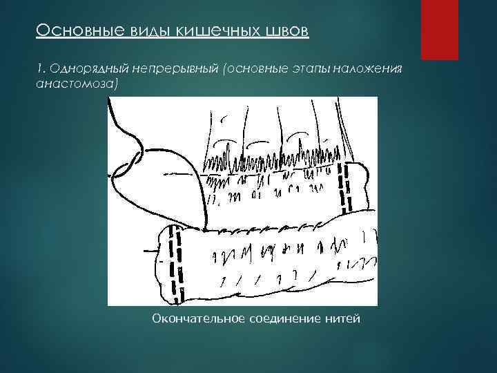 Основные виды кишечных швов 1. Однорядный непрерывный (основные этапы наложения анастомоза) Окончательное соединение нитей