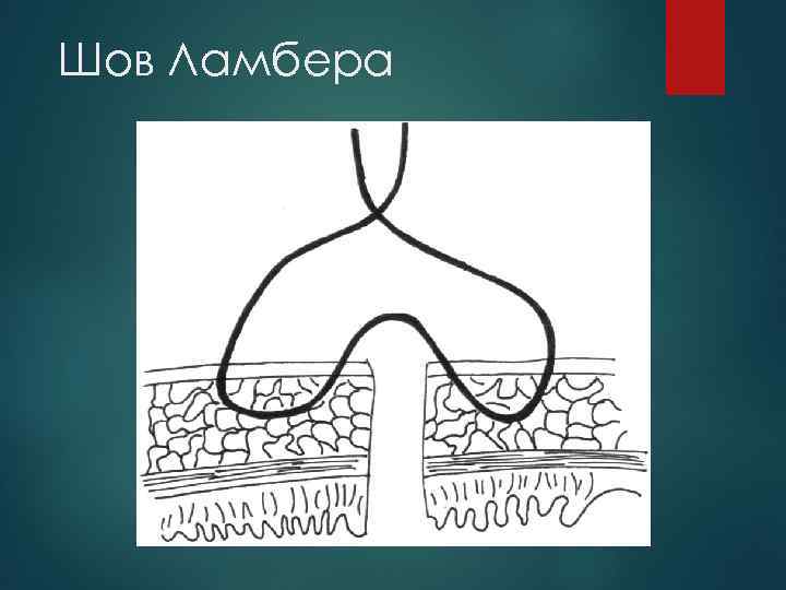 Шов Ламбера 