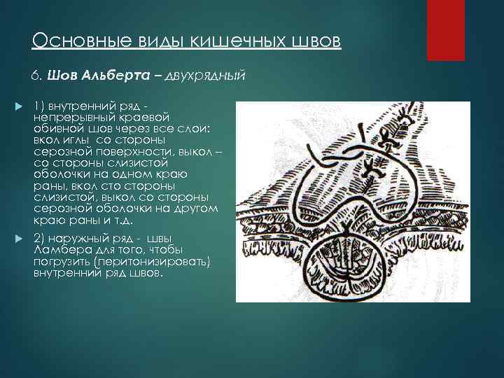 Основные виды кишечных швов 6. Шов Альберта – двухрядный 1) внутренний ряд непрерывный краевой