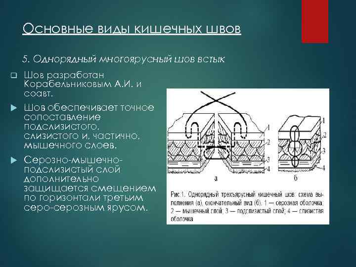 Основные виды кишечных швов 5. Однорядный многоярусный шов встык q Шов разработан Корабельниковым А.