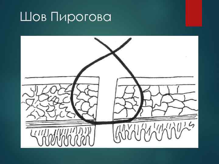 Шов Пирогова 