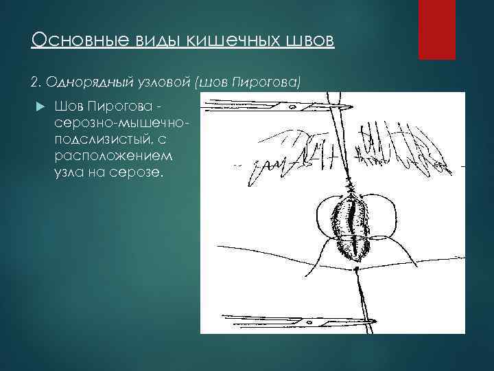 Основные виды кишечных швов 2. Однорядный узловой (шов Пирогова) Шов Пирогова серозно-мышечноподслизистый, с расположением