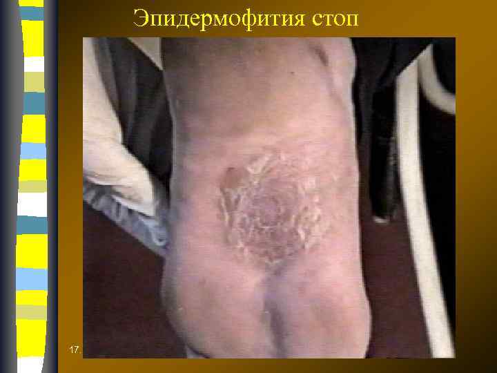 Эпидермофития стоп 17. 02. 2018 