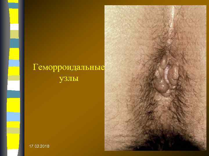 Геморроидальные узлы 17. 02. 2018 
