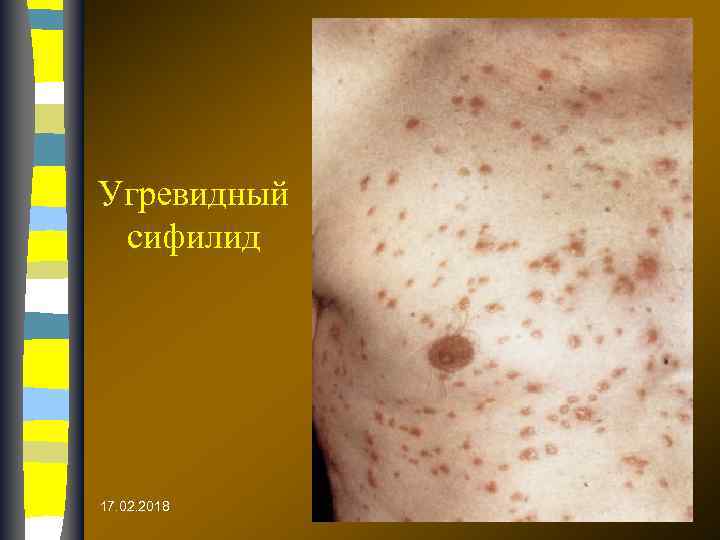 Угревидный сифилид 17. 02. 2018 