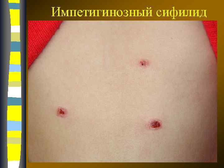 Импетигинозный сифилид 17. 02. 2018 