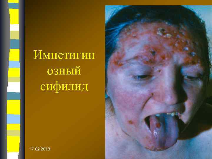 Импетигин озный сифилид 17. 02. 2018 