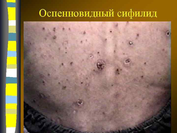 Оспенновидный сифилид 17. 02. 2018 