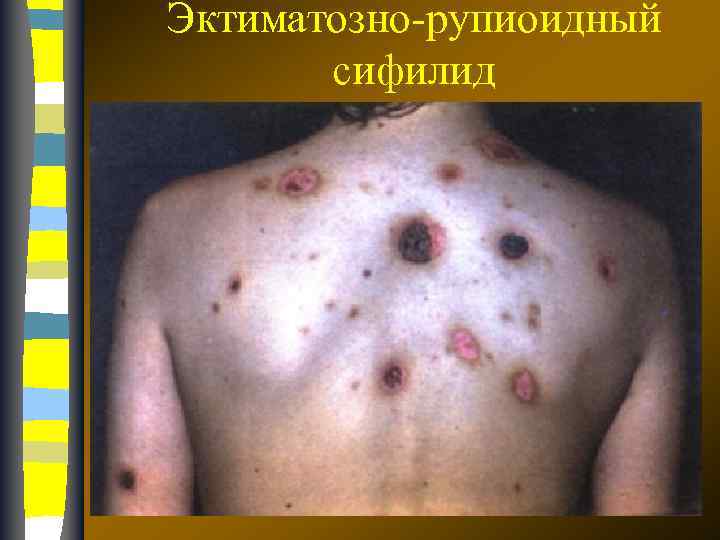 Эктиматозно-рупиоидный сифилид 17. 02. 2018 