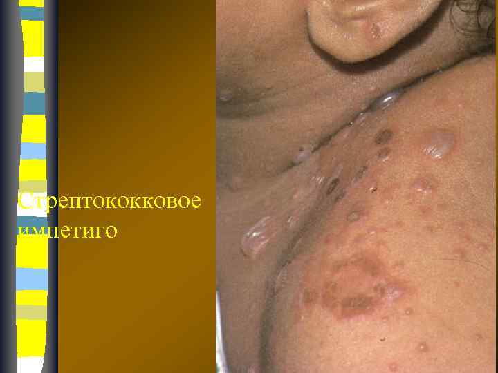 Стрептококковое импетиго 