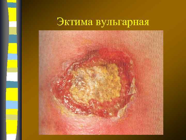 Эктима вульгарная 