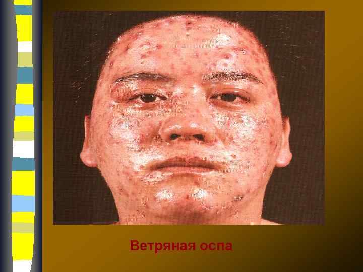 Ветряная оспа 