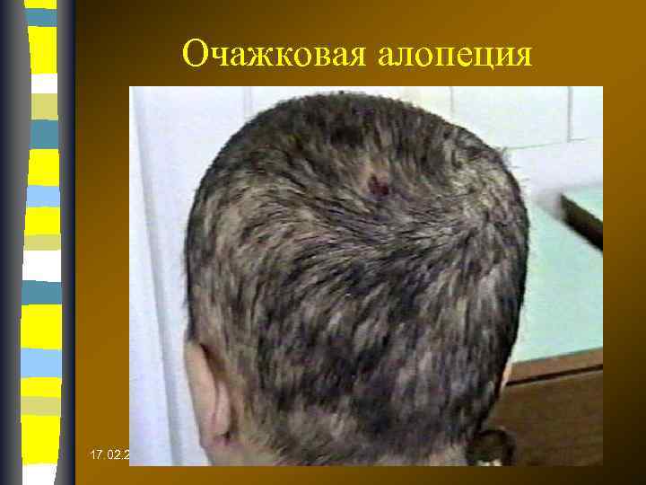 Очажковая алопеция 17. 02. 2018 