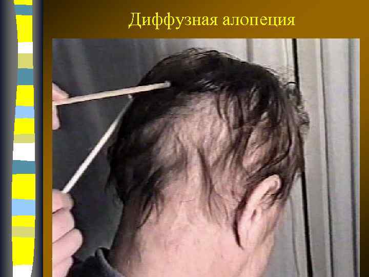 Диффузная алопеция 17. 02. 2018 