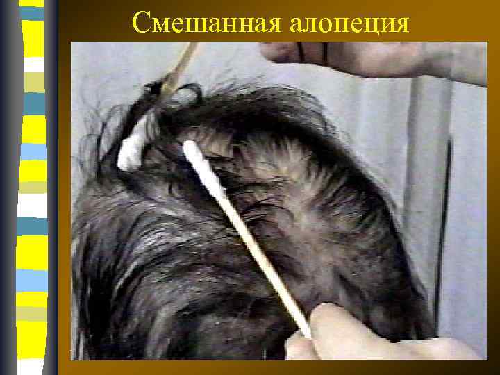 Смешанная алопеция 17. 02. 2018 