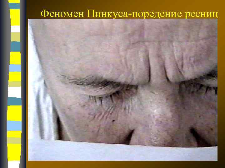 Феномен Пинкуса-поредение ресниц 17. 02. 2018 