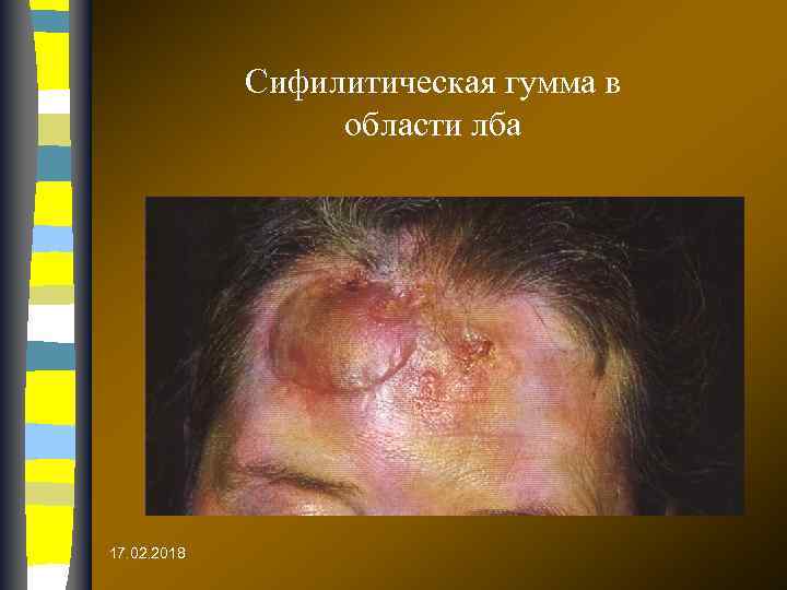 Сифилитическая гумма в области лба 17. 02. 2018 