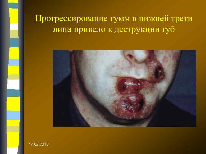 Прогрессирование гумм в нижней трети лица привело к деструкции губ 17. 02. 2018 