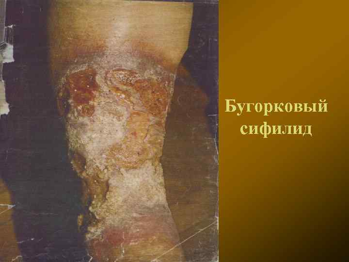 Бугорковый сифилид 