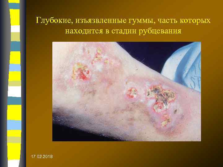 Глубокие, изъязвленные гуммы, часть которых находится в стадии рубцевания 17. 02. 2018 