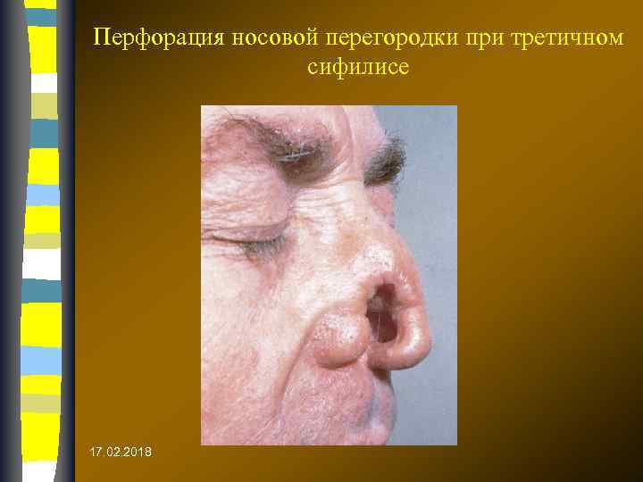 Перфорация носовой перегородки при третичном сифилисе 17. 02. 2018 