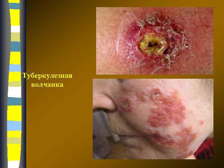 Туберкулезная волчанка 