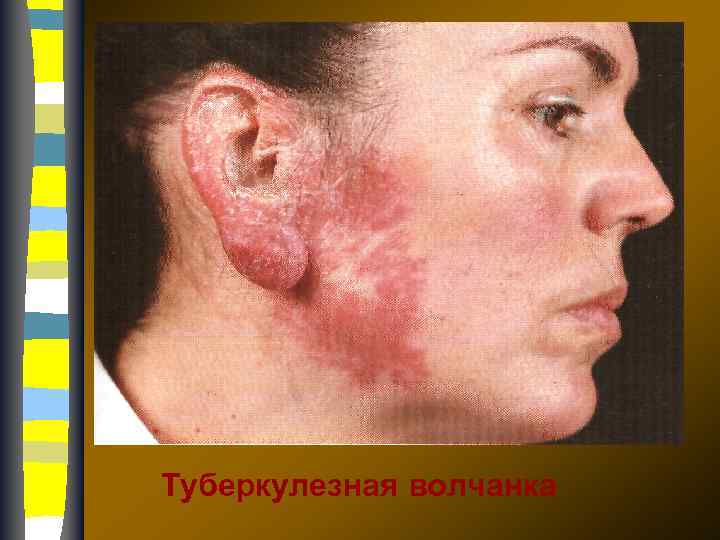 Туберкулезная волчанка 
