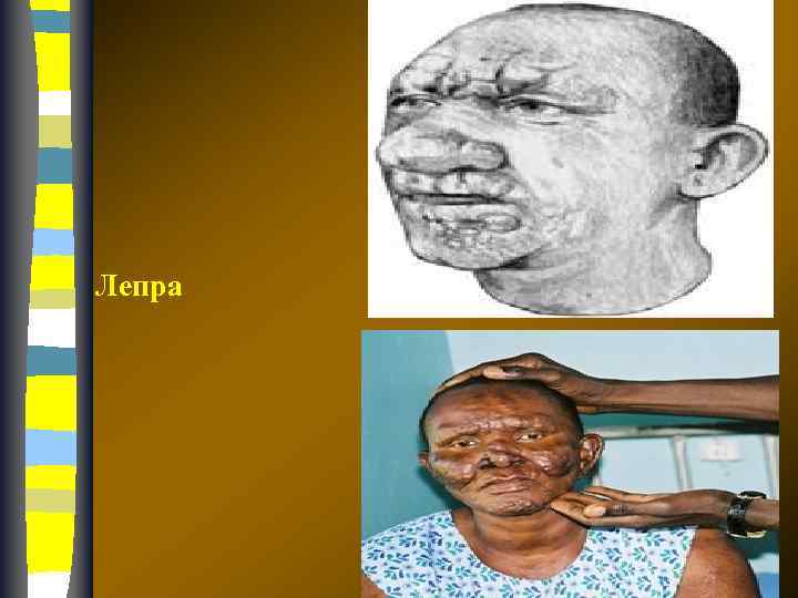 Лепра 